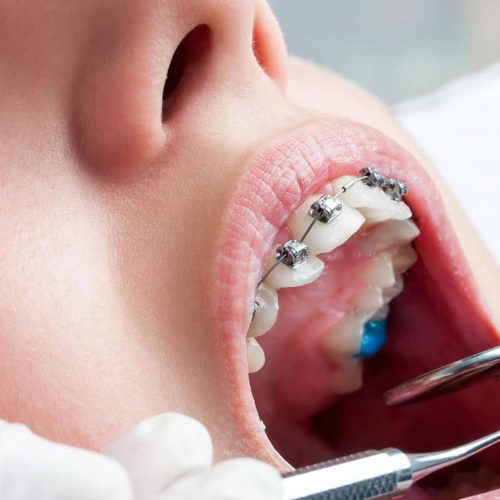 CÓMO AYUDAR A TUS HIJOS A UTILIZAR BRACKETS EN LEON CÓMO AYUDAR A TUS HIJOS A UTILIZAR BRACKETS EN LEON