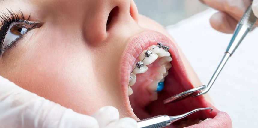 CÓMO AYUDAR A TUS HIJOS A UTILIZAR BRACKETS EN LEON CÓMO AYUDAR A TUS HIJOS A UTILIZAR BRACKETS EN LEON