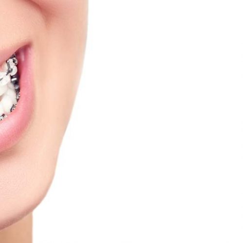 4 CONSEJOS DE CUIDADO DE LOS BRACKETS 4 CONSEJOS DE CUIDADO DE LOS BRACKETS