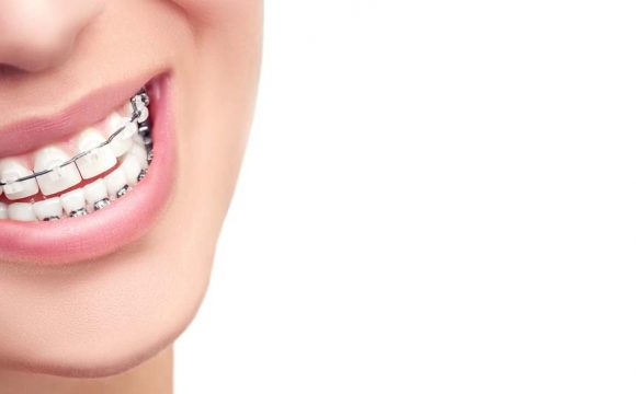 4 CONSEJOS DE CUIDADO DE LOS BRACKETS 4 CONSEJOS DE CUIDADO DE LOS BRACKETS