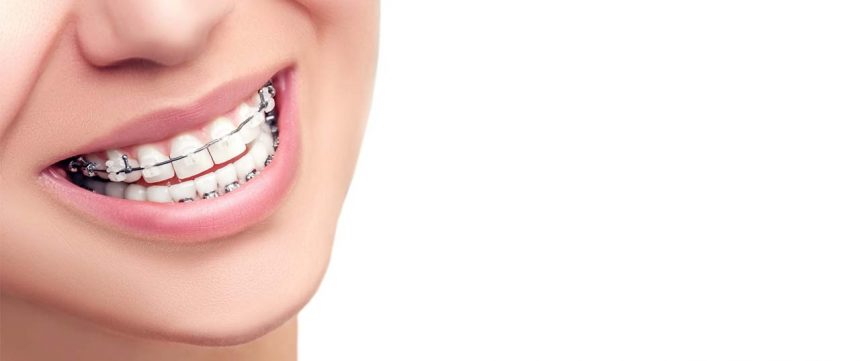 4 CONSEJOS DE CUIDADO DE LOS BRACKETS 4 CONSEJOS DE CUIDADO DE LOS BRACKETS