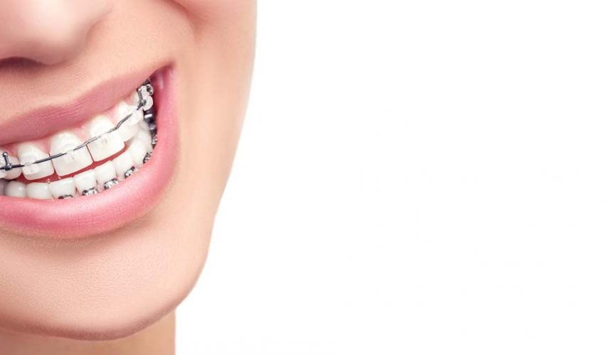 4 CONSEJOS DE CUIDADO DE LOS BRACKETS 4 CONSEJOS DE CUIDADO DE LOS BRACKETS