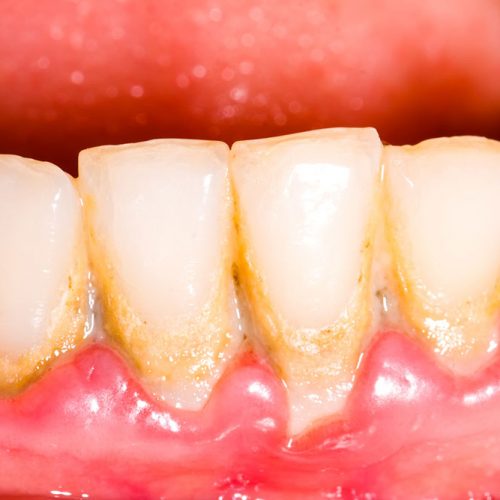 PERIODONCIA EN LEÓN, SOBRE EL DIAGNÓSTICO Y EL TRATAMIENTO DE LA PERIODONTITIS. PERIODONCIA EN LEÓN, SOBRE EL DIAGNÓSTICO Y EL TRATAMIENTO DE LA PERIODONTITIS.