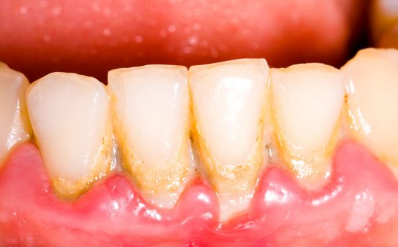PERIODONCIA EN LEÓN, SOBRE EL DIAGNÓSTICO Y EL TRATAMIENTO DE LA PERIODONTITIS. PERIODONCIA EN LEÓN, SOBRE EL DIAGNÓSTICO Y EL TRATAMIENTO DE LA PERIODONTITIS.