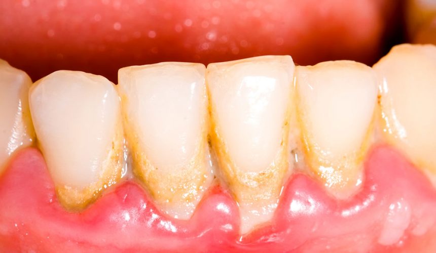 PERIODONCIA EN LEÓN, SOBRE EL DIAGNÓSTICO Y EL TRATAMIENTO DE LA PERIODONTITIS. PERIODONCIA EN LEÓN, SOBRE EL DIAGNÓSTICO Y EL TRATAMIENTO DE LA PERIODONTITIS.