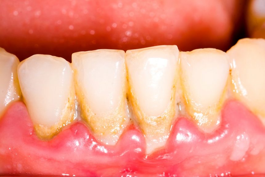 PERIODONCIA EN LEÓN, SOBRE EL DIAGNÓSTICO Y EL TRATAMIENTO DE LA PERIODONTITIS. PERIODONCIA EN LEÓN, SOBRE EL DIAGNÓSTICO Y EL TRATAMIENTO DE LA PERIODONTITIS.