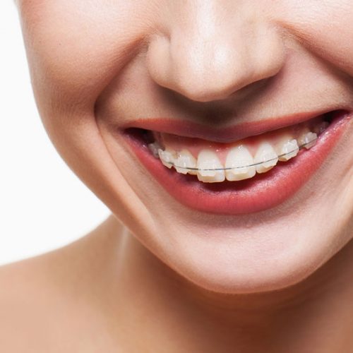 LA IMPORTANCIA DEL TRATAMIENTO CON BRACKETS EN LEÓN LA IMPORTANCIA DEL TRATAMIENTO CON BRACKETS EN LEÓN