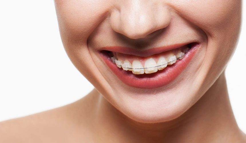 LA IMPORTANCIA DEL TRATAMIENTO CON BRACKETS EN LEÓN LA IMPORTANCIA DEL TRATAMIENTO CON BRACKETS EN LEÓN