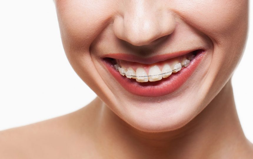 LA IMPORTANCIA DEL TRATAMIENTO CON BRACKETS EN LEÓN