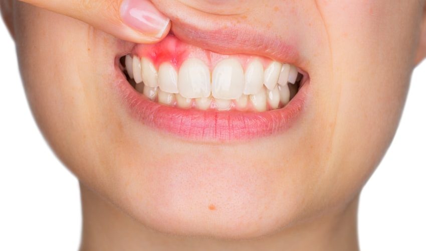 QUÉ ES LA PIORREA O ENFERMEDAD PERIODONTAL Y QUÉ LA OCASIONA QUÉ ES LA PIORREA O ENFERMEDAD PERIODONTAL Y QUÉ LA OCASIONA